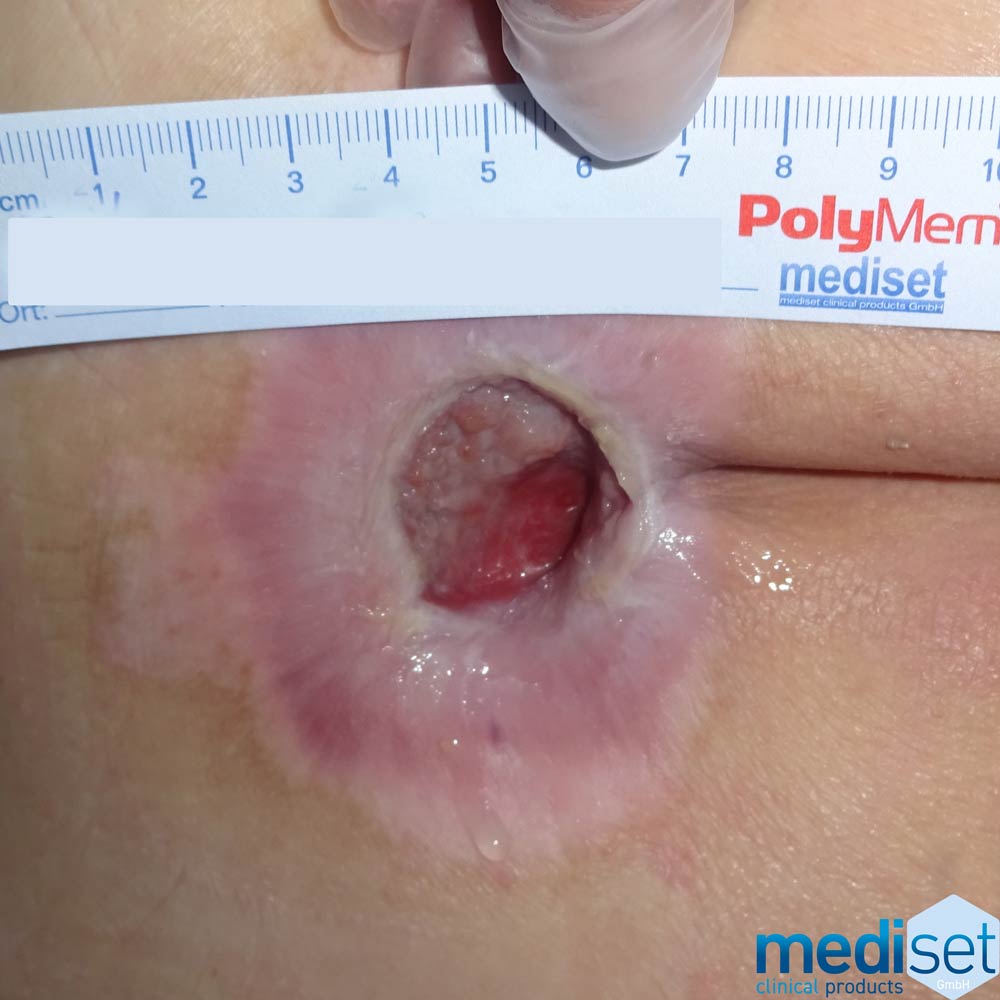 Granulationsphase Wundversorung Wundheilungsphasen Wundgranulat